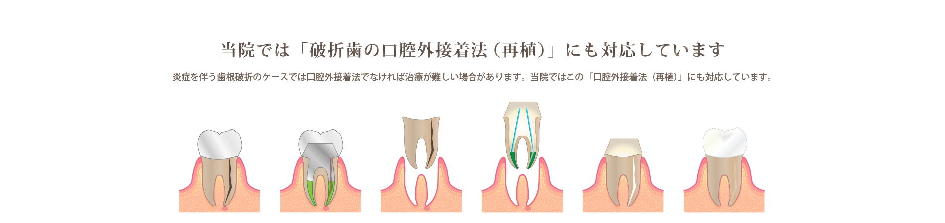 荒川区西日暮里 歯根破折歯の治療 破折歯接着治療 わかるサイト